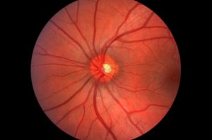 Glaucoma Treatment in Steamboat Springs